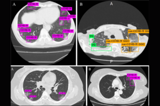 CT imaging enhanced by artificial intelligence to effectively diagnose COVID-19