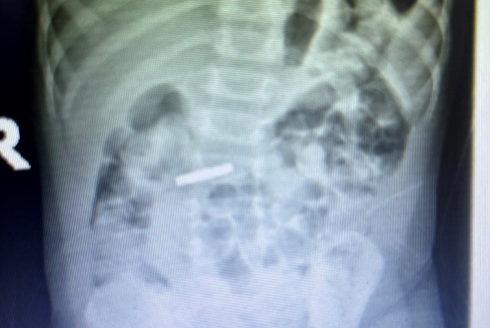 ingested object