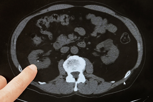 A Kidney Stone is spotted on an X-ray