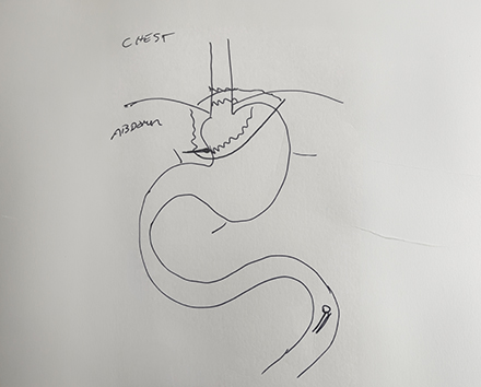 A white piece of cardboard with a hand drawn diagram of hital hernia
