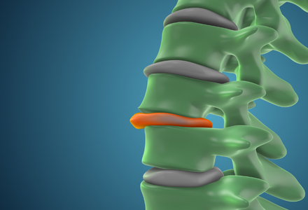 An illustration of a slipped disc in the spine.