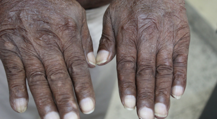 hand afflicted with leprosy