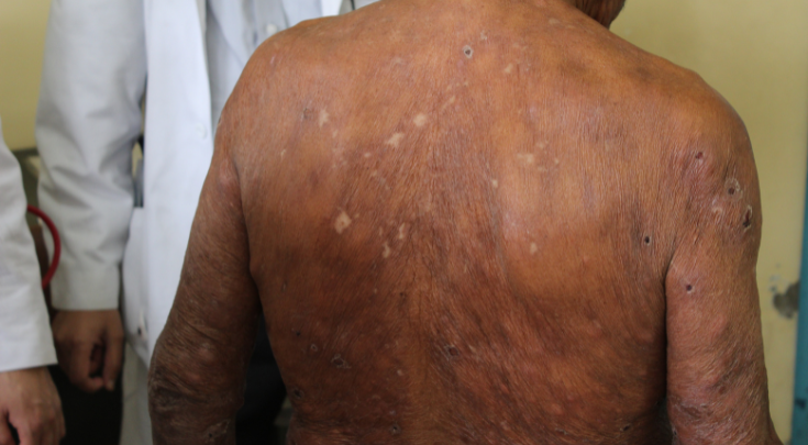 a man's back affected by leprosy