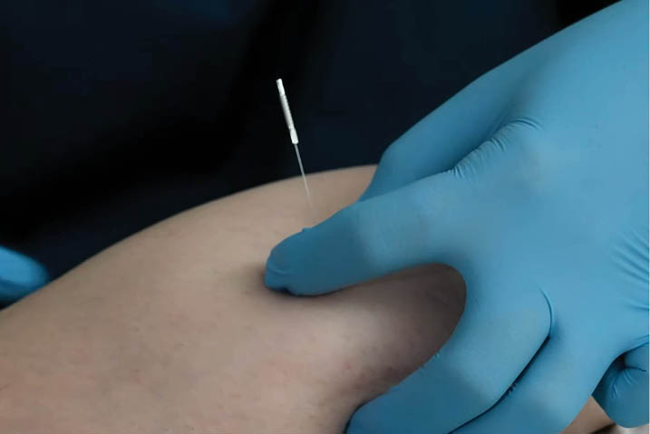 A gloved hand administering a dry needling treatment 