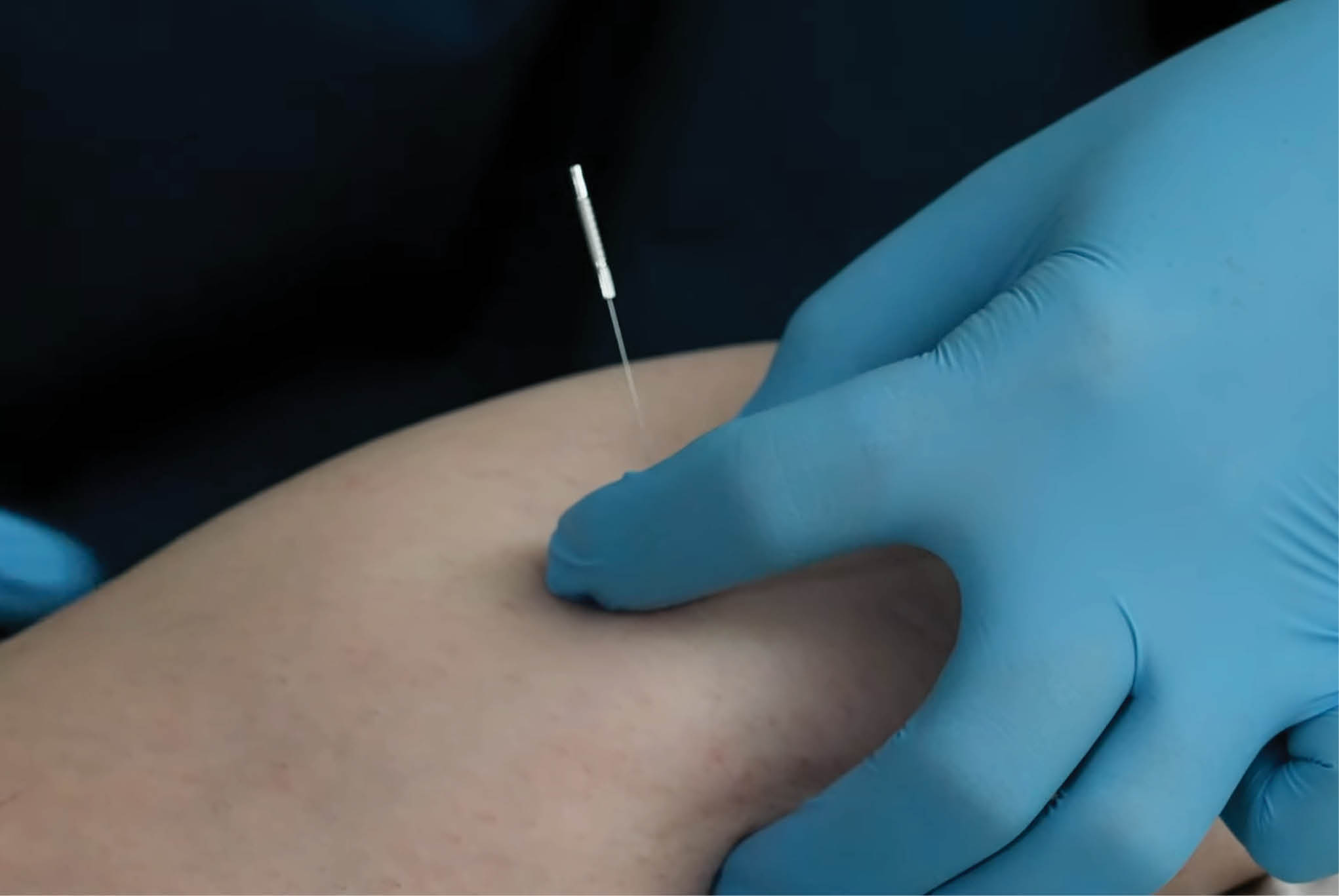 Image of a gloved hand administering a microneedling treatment