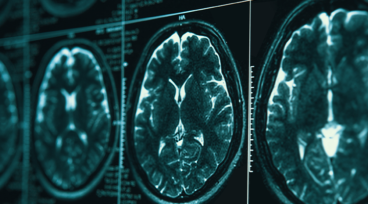 brain scans