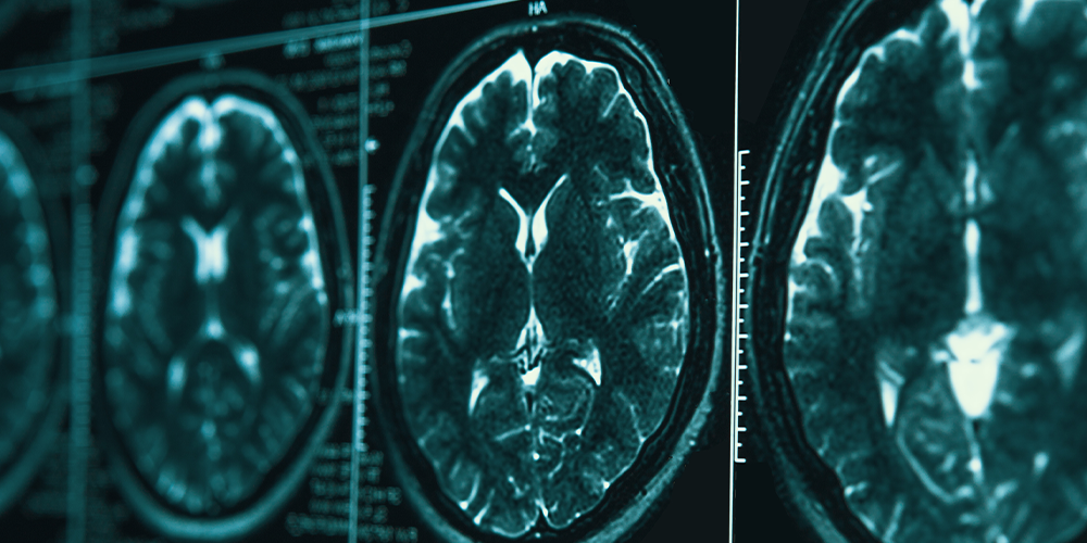 Black and blue glowing brain scan